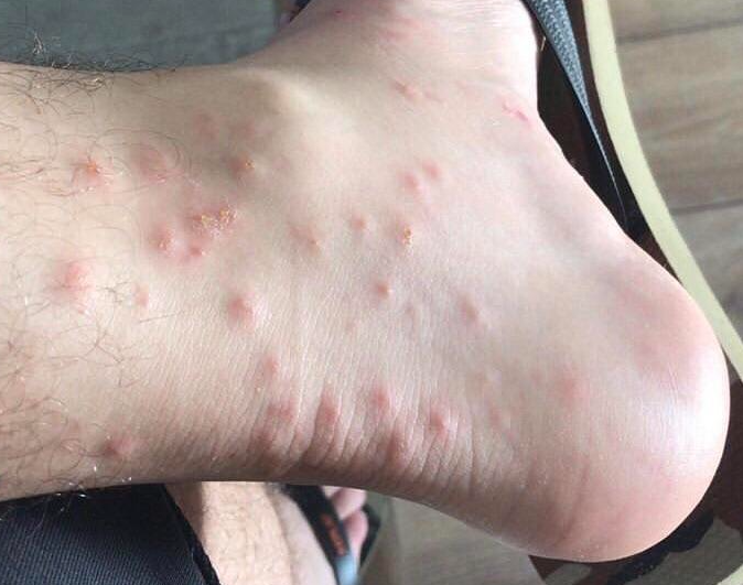 Fire Ants Bite sign
